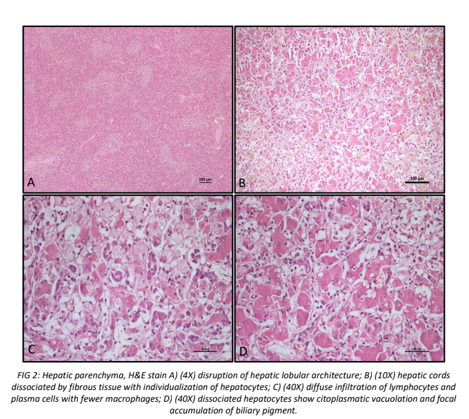 A CASE OF LOBULAR DISSECTING HEPATITIS (LDH) IN A MIXED BREED DOG  CLINICAL, DIAGNOSTIC AND PATHOLOGICAL ASPECTS.